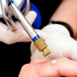 crioterapia-dermomedica-dermatologia-en-los-olivos-lima-peru